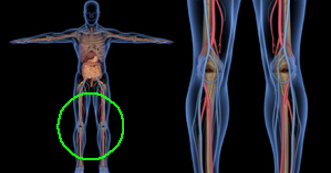 Sciatica Pain image