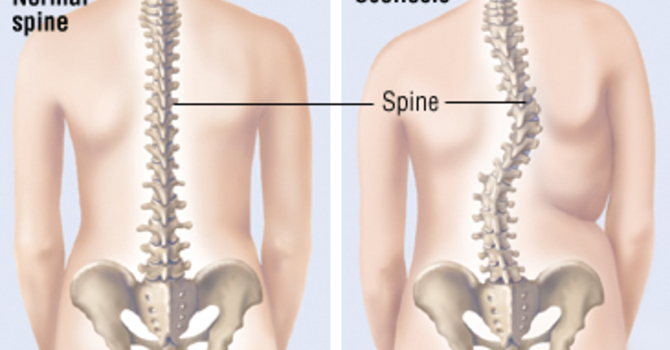 Chiropractic: Slowing the Progression of Scoliosis image