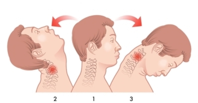 Chiropractic Care and Whiplash Injuries image