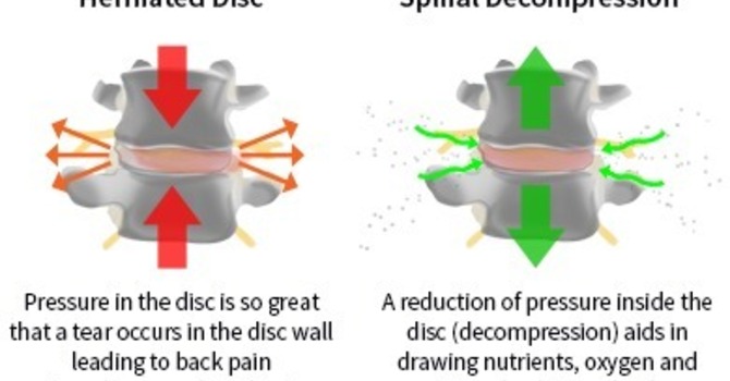 Can Spinal Decompression Be The Missing Piece? image