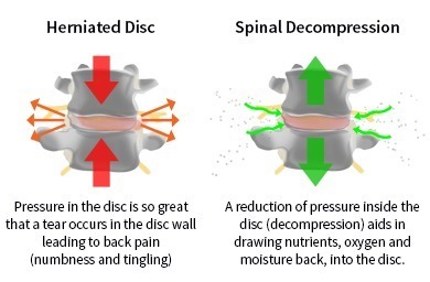 chiropractor in Rochester