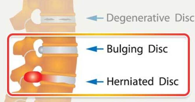 Disc Bulge vs Disc Herniation – Which is worse? image